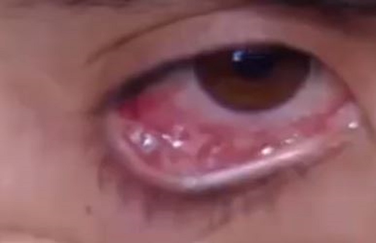 आँखाबाट आँशु हैन दैनिक ५० क्रिस्टल निस्किएपछि