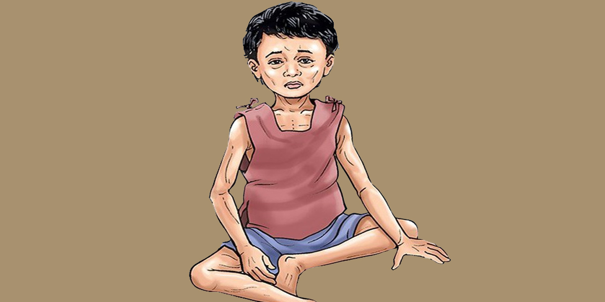 दार्चुलाका १६८ बालबालिकालाई कडा कुपोषण