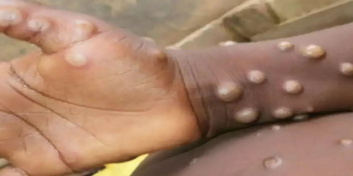 मंकीपक्स फैलिएपछि संसारभर स्वास्थ्य आपतकाल घोषणा