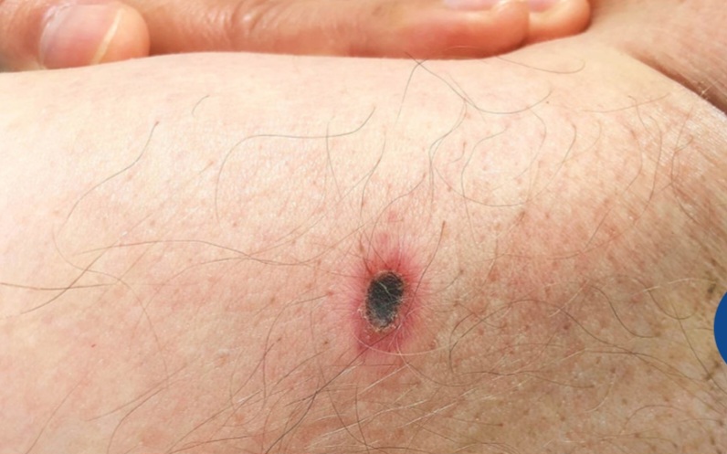 सुदूरपश्चिमका पहाडी जिल्लामा फैलिँदै स्क्रब टाइफस