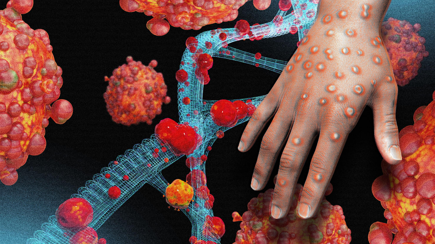 भारतमा ९ जनामा मंकीपक्स संक्रमण पुष्टि